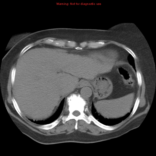 Bronchoalveolar carcinoma (Radiopaedia 13224-13233 Axial non-contrast 37).jpg