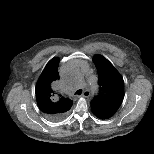 Bronchogenic carcinoma with metastatic lymphadenopathy (Radiopaedia 37671-39569 Axial non-contrast 16).jpg