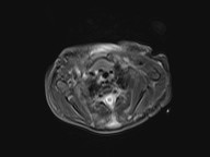 File:Bronchogenic cyst (Radiopaedia 27207-27380 Axial STIR 14).jpg