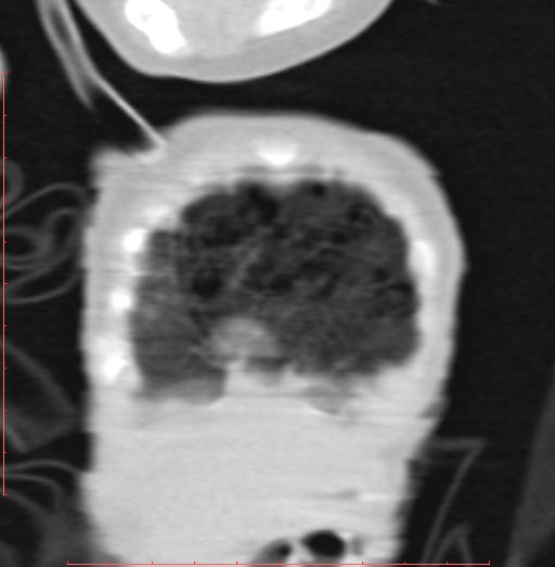 Bronchogenic cyst (Radiopaedia 78599-91409 Coronal lung window 23).jpg