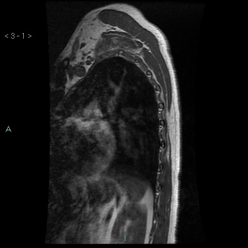 File:Bronchogenic cyst - posterior mediastinal (Radiopaedia 43885-47365 Sagittal T1 1).jpg