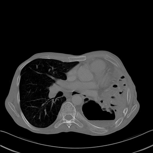 File:Bronchopleural fistula secondary to tuberculosis (Radiopaedia 20415-20322 Axial bone window 16).jpg