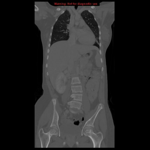 File:Brown tumor (Radiopaedia 12318-12596 D 34).jpg