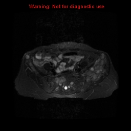 File:Brown tumors (Radiopaedia 9666-10290 Axial T2 fat sat 7).jpg