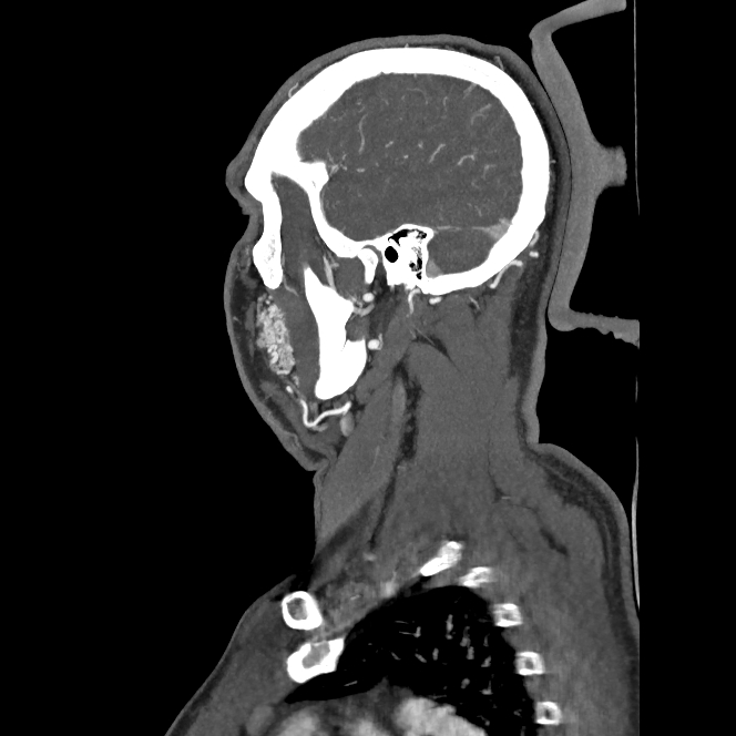 Buccal fat pad arteriovenous malformation (Radiopaedia 70936-81144 C 31).jpg