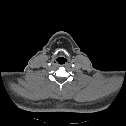 Buccal fat pad arteriovenous malformation (Radiopaedia 70936-81144 D 116).jpg