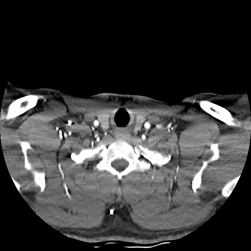 Buccal fat pad arteriovenous malformation (Radiopaedia 70936-81144 D 61).jpg