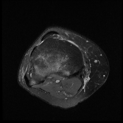 File:Bucket handle meniscus tear (Radiopaedia 56916-63751 Axial PD fat sat 17).jpg