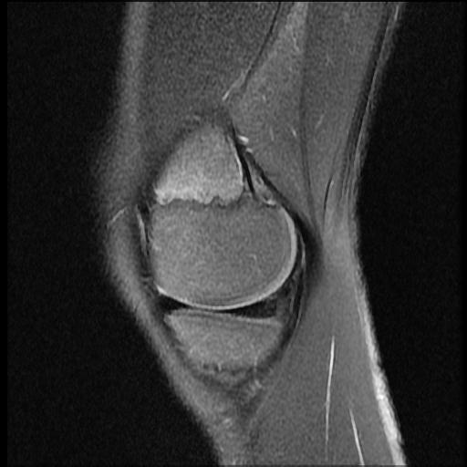 File:Bucket handle tear - lateral meniscus (Radiopaedia 72124-82634 Sagittal PD fat sat 13).jpg
