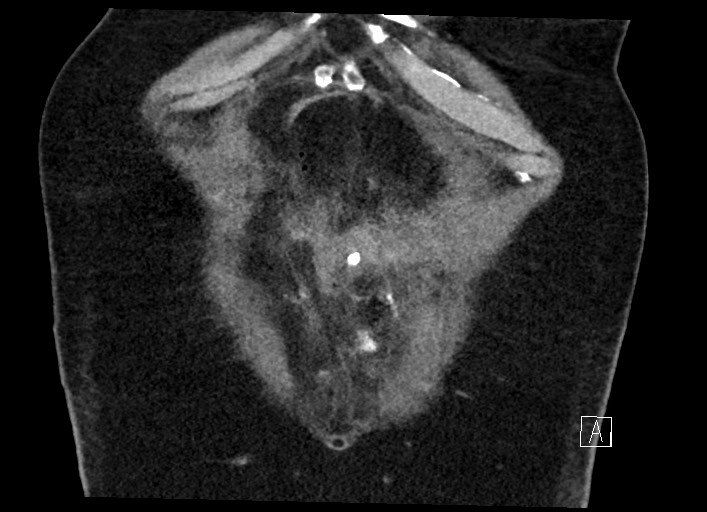 Buried bumper syndrome - gastrostomy tube (Radiopaedia 63843-72577 Coronal Inject 20).jpg