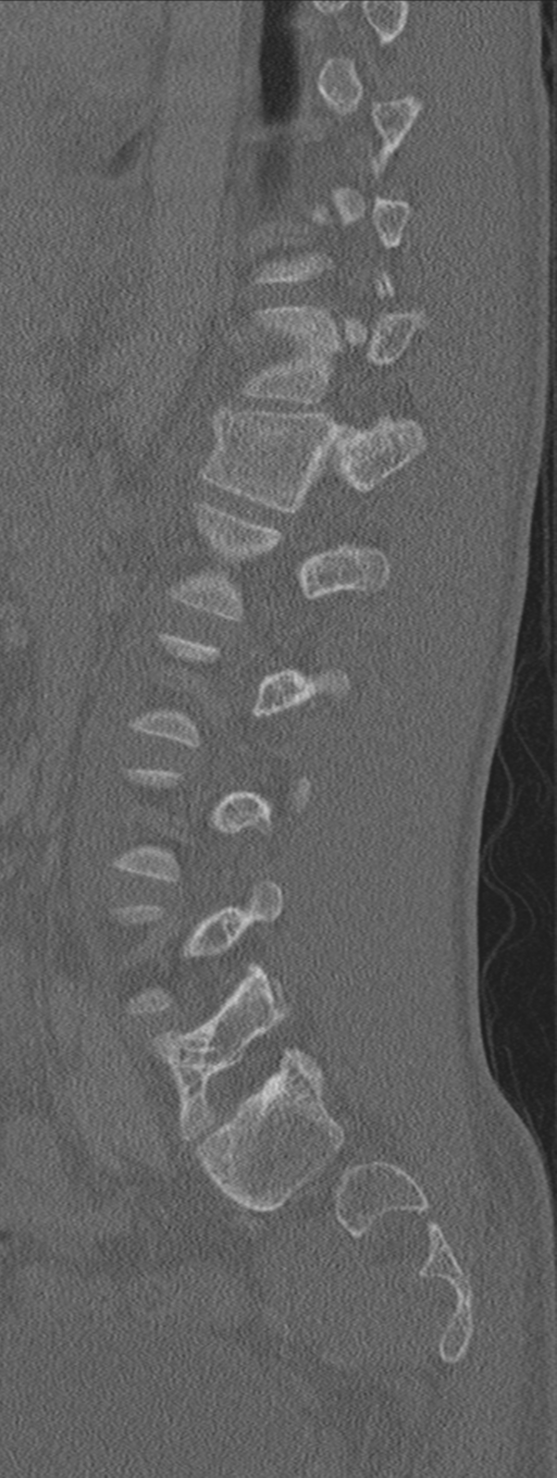 Burst fracture - T12 with conus compression (Radiopaedia 56825-63647 Sagittal bone window 28).png