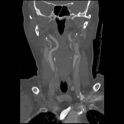 C1 anterior arch (plough) fracture - type 1 (Radiopaedia 76181-87720 Coronal bone window 70).jpg