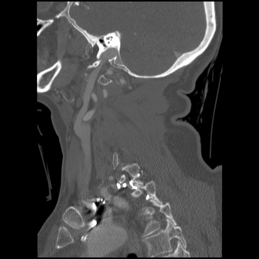 File:C1 anterior arch (plough) fracture - type 1 (Radiopaedia 76181-87720 Sagittal bone window 34).jpg