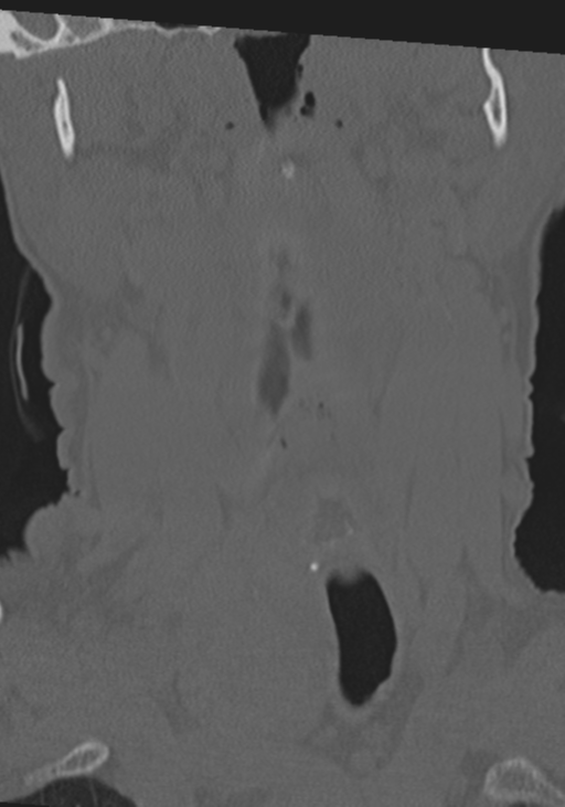 C2 fracture with vertebral artery dissection (Radiopaedia 37378-39199 Coronal bone window 4).png