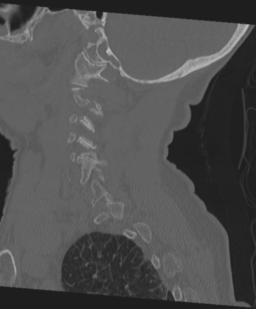 C2 fracture with vertebral artery dissection (Radiopaedia 37378-39199 Sagittal bone window 56).png