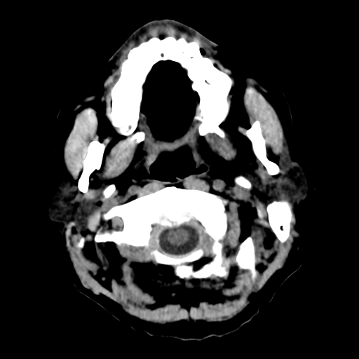 File:CNS lymphoma (Radiopaedia 36983-38639 Axial non-contrast 5).png