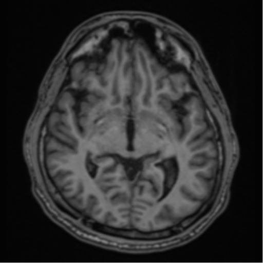 CNS vasculitis (Radiopaedia 55715-62263 Axial T1 21).png