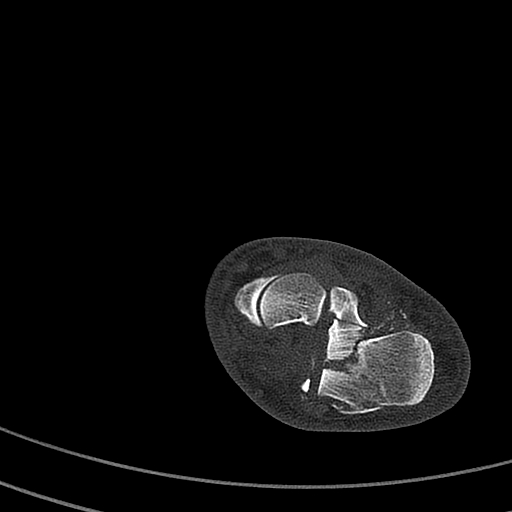 Calcaneal fracture - Sanders type 4 (Radiopaedia 90179-107370 Axial bone window 32).jpg