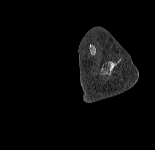 Calcaneal fracture - Sanders type 4 (Radiopaedia 90179-107370 Sagittal bone window 78).jpg