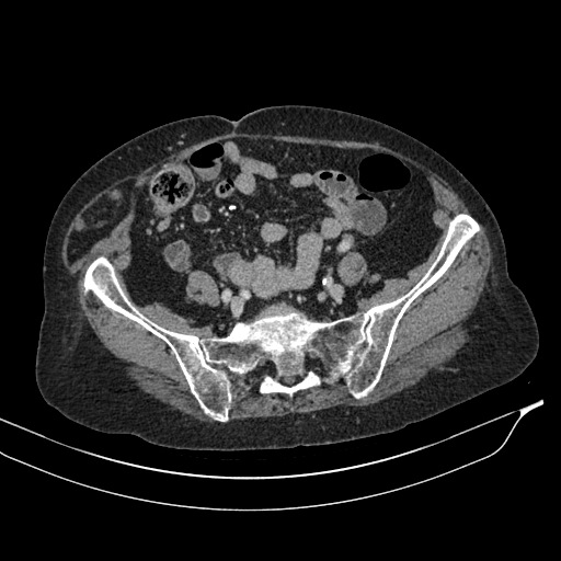 Calcified adrenal glands and Spigelian hernia (Radiopaedia 49741-54988 A 170).jpg