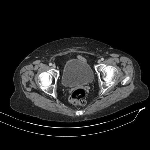 Calcified adrenal glands and Spigelian hernia (Radiopaedia 49741-54988 A 227).jpg