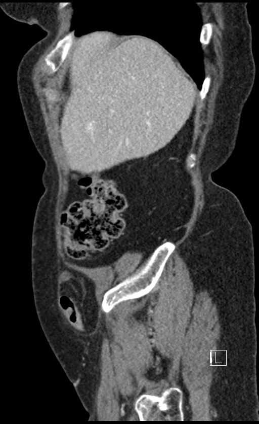 Calcified adrenal glands and Spigelian hernia (Radiopaedia 49741-54988 C 138).jpg