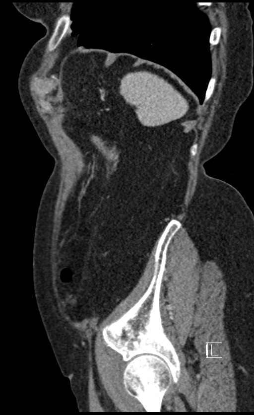 Calcified adrenal glands and Spigelian hernia (Radiopaedia 49741-54988 C 27).jpg