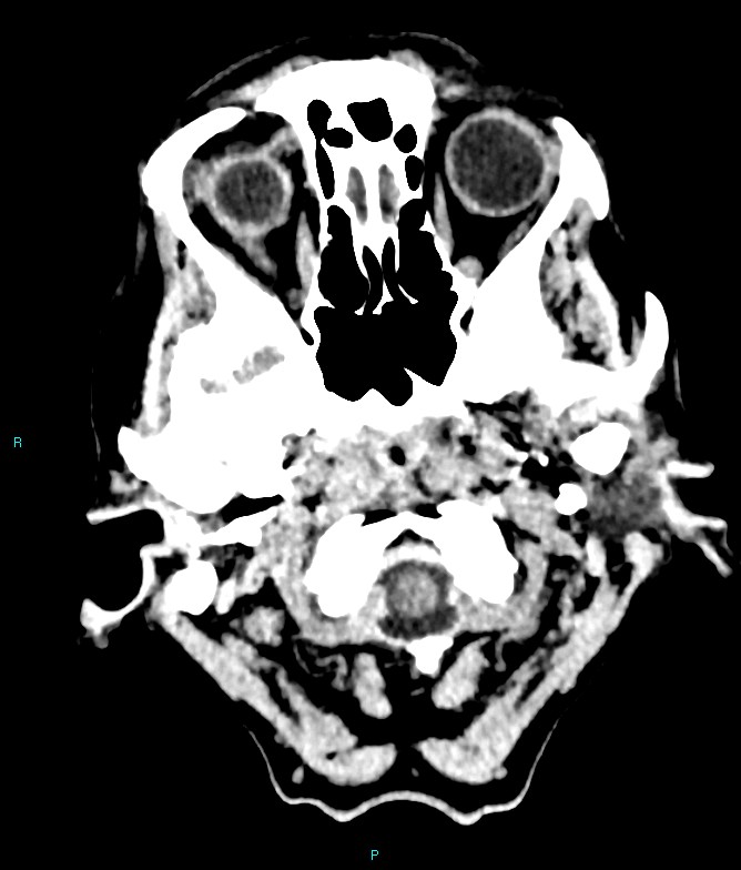 Calcified cerebral emboli from left ventricular thrombus (Radiopaedia 84420-99758 Axial non-contrast 83).jpg