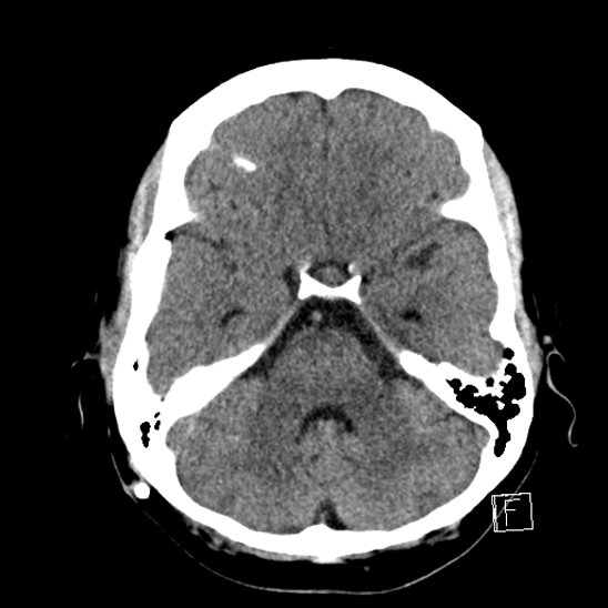 File:Calcified chronic subdural hematoma (Radiopaedia 77374-89492 Axial non-contrast 14).jpg
