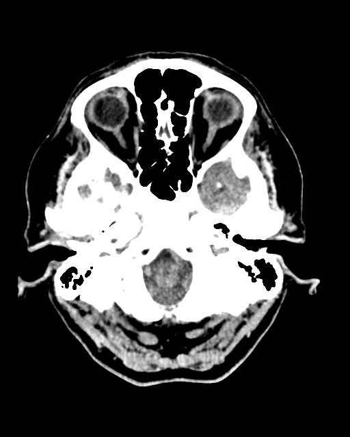 Calcified meningioma (Radiopaedia 74361-85243 Axial non-contrast 44).jpg