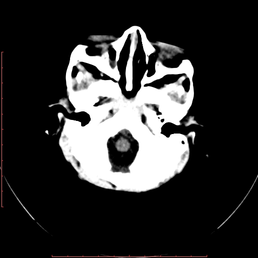 File:Calcified middle cerebral artery embolism (Radiopaedia 78949-91860 Axial non-contrast 3).jpg