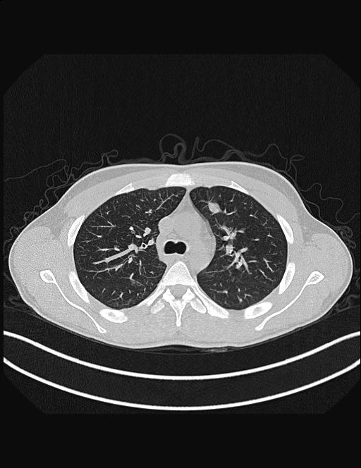 Calcifying pulmonary metastases (Radiopaedia 33359-34396 Axial lung window 21).jpg