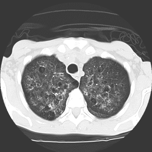 File:Calciphylaxis and metastatic pulmonary calcification (Radiopaedia 10887-11317 Axial lung window 5).jpg