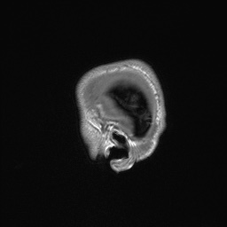 Callosal dysgenesis with interhemispheric cyst (Radiopaedia 53355-59335 Sagittal T1 12).jpg