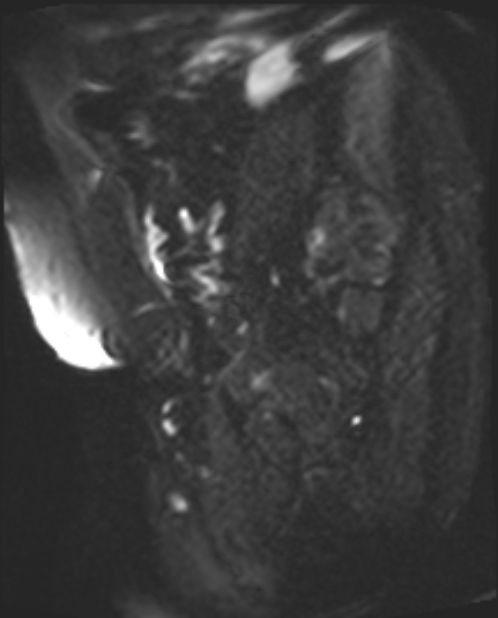 Cancer cervix - stage IIb (Radiopaedia 75411-86615 Sagittal DWI 22).jpg
