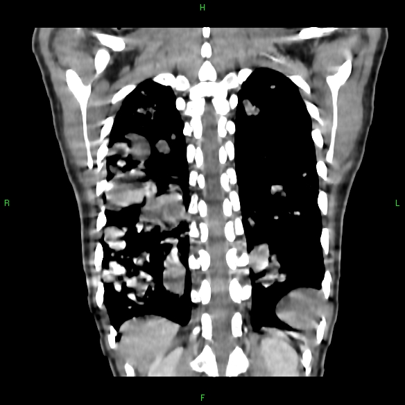File:Cannon ball metastases - synovial sarcoma (Radiopaedia 26135-26271 Coronal liver window 18).jpg