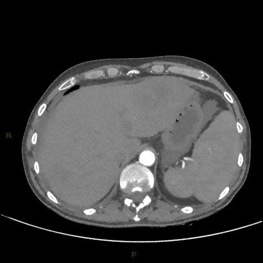 File:Cannonball metastases (Radiopaedia 82110-96150 Axial C+ CTPA 294).jpg