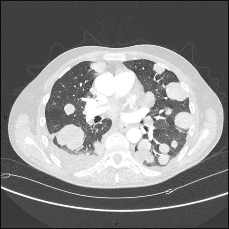 Cannonball metastases (Radiopaedia 82110-96150 Axial lung window 100).jpg