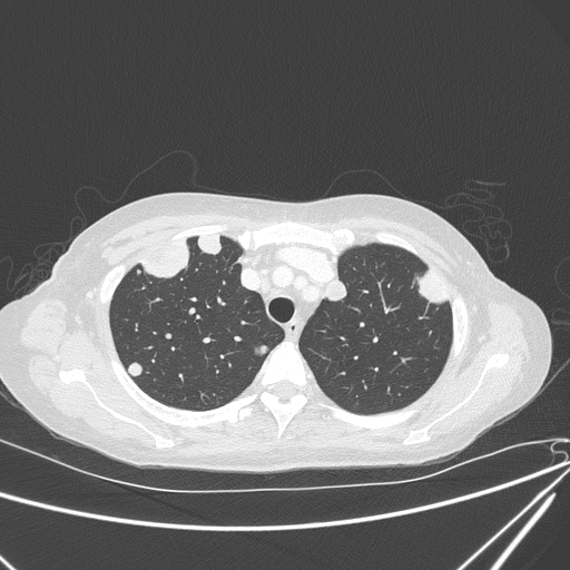 File:Canonball lung metastasis (Radiopaedia 77634-89837 Axial lung window 42).jpg
