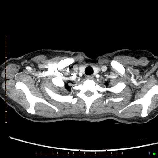 Canonball lung metastasis (Radiopaedia 77634-89837 B 3).jpg