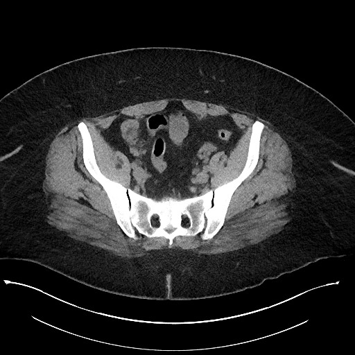 Carcinoid tumor - terminal ileum (Radiopaedia 60931-68740 Axial non-contrast 94).jpg