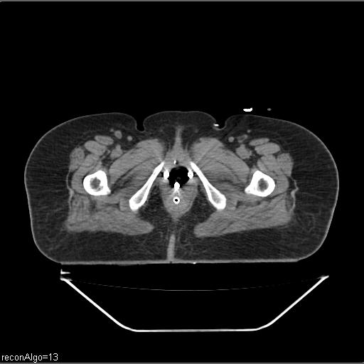Carcinoma cervix- brachytherapy applicator (Radiopaedia 33135-34173 Axial non-contrast 50).jpg