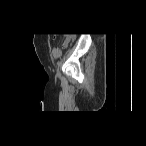Carcinoma cervix- brachytherapy applicator (Radiopaedia 33135-34173 D 19).jpg