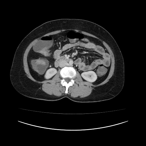 File:Carcinoma colon - hepatic flexure (Radiopaedia 19461-19493 A 61).jpg