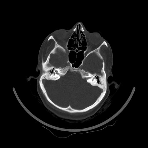 Carcinoma of the maxillary antrum (Radiopaedia 53805-59888 Axial bone window 31).jpg