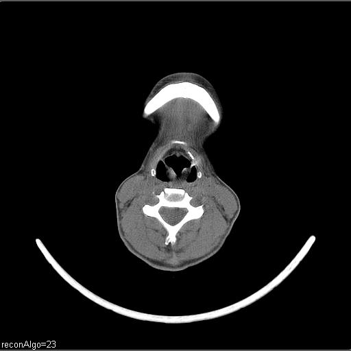 Carcinoma of the maxillary antrum (Radiopaedia 53805-59888 Axial non-contrast 30).jpg