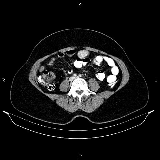 Carcinoma of uterine cervix (Radiopaedia 85861-101700 A 55).jpg