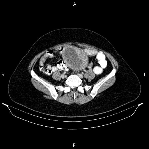 Carcinoma of uterine cervix (Radiopaedia 85861-101700 A 60).jpg