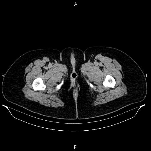 File:Carcinoma of uterine cervix (Radiopaedia 85861-101700 Axial C+ delayed 102).jpg