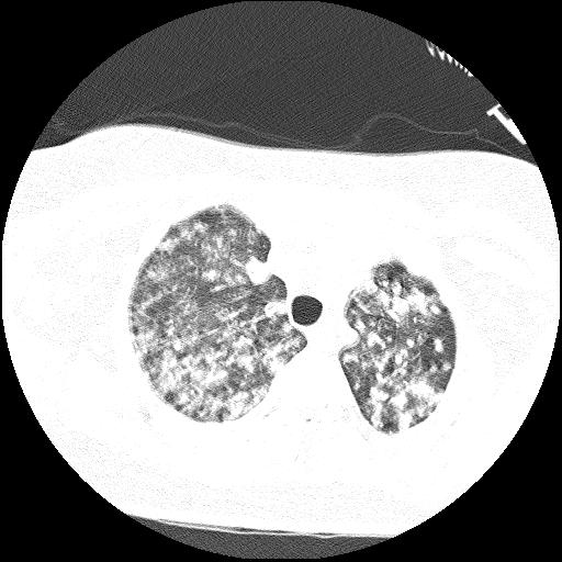 Cardiac angiosarcoma (Radiopaedia 66010-75181 Axial lung window 74).jpg